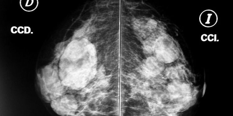 La mamografía es una de las pruebas que ayuda a detectar precozmente el cáncer de mama.