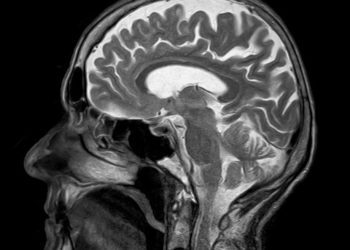 Resonancia magnética de un cerebro humano.