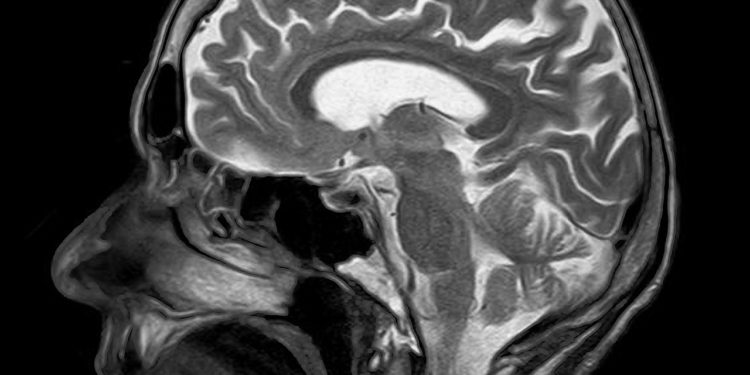 Resonancia magnética de un cerebro humano.