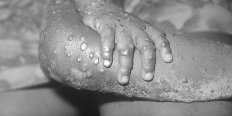 Foto: CDC's Public Health Image Library