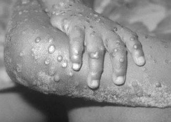 Imagen de archivo de una persona afectada por viruela del mono.