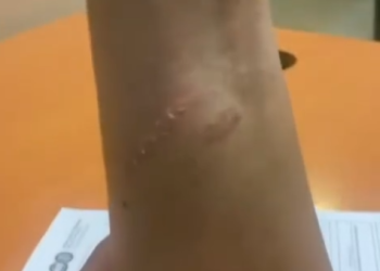 Heridas en el brazo de la mujer asaltada para robarle el reloj.