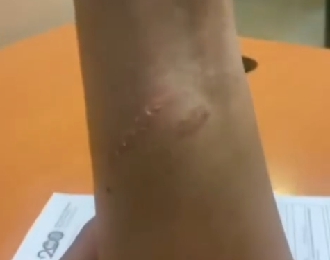 Heridas en el brazo de la mujer asaltada para robarle el reloj.