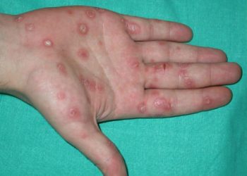 Clavos sifilíticos en un paciente con sífilis. Foto Portaldelsur Flickr