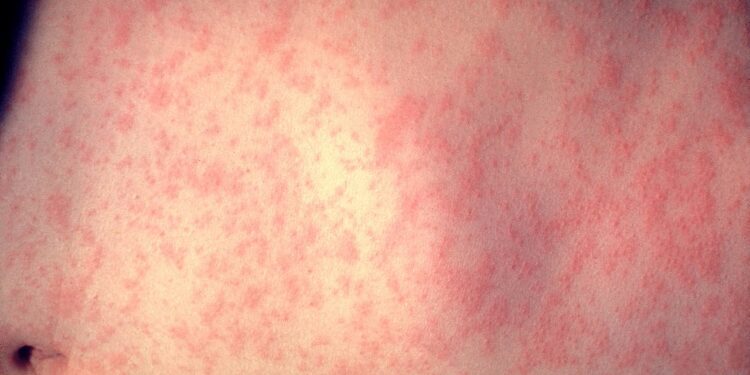 Piel afectada de sarampión. De Photo Credit:Content Providers(s): CDC/Dr. Heinz F. Eichenwald - This media comes from the Centers for Disease Control and Prevention's Public Health Image Library (PHIL), Wikipedia