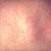 Piel afectada de sarampión. De Photo Credit:Content Providers(s): CDC/Dr. Heinz F. Eichenwald - This media comes from the Centers for Disease Control and Prevention's Public Health Image Library (PHIL), Wikipedia
